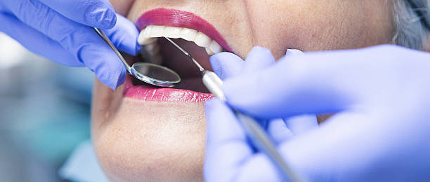 Best Emergency Root Canal Treatment in Clemson University, SC